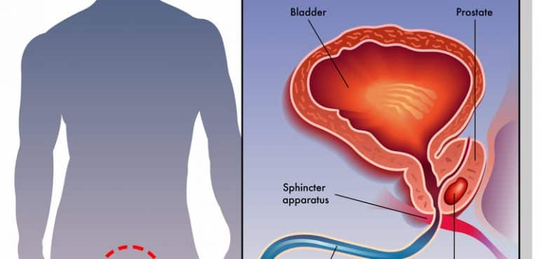 Prostate and ED Problems: Does Prostate Cancer Cause Impotence?